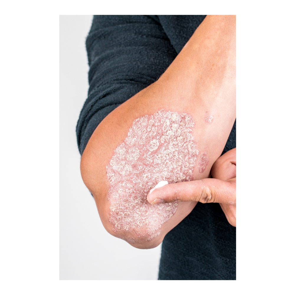 Psoriasis : causes, symptômes et traitements pour mieux vivre avec cette maladie de peau Image